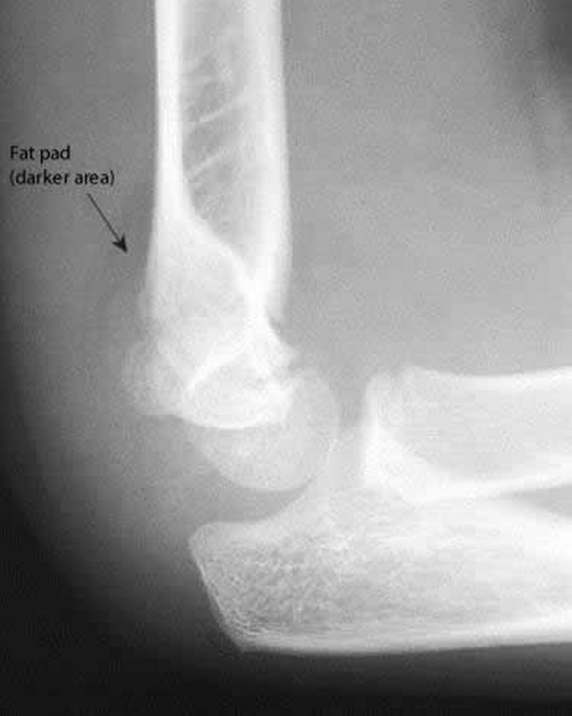 A lmohadilla de grasa posterior
