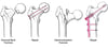 Open Reduction With Internal Fixation (ORIF)