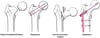 Offene Reposition mit interner Fixierung (ORIF)