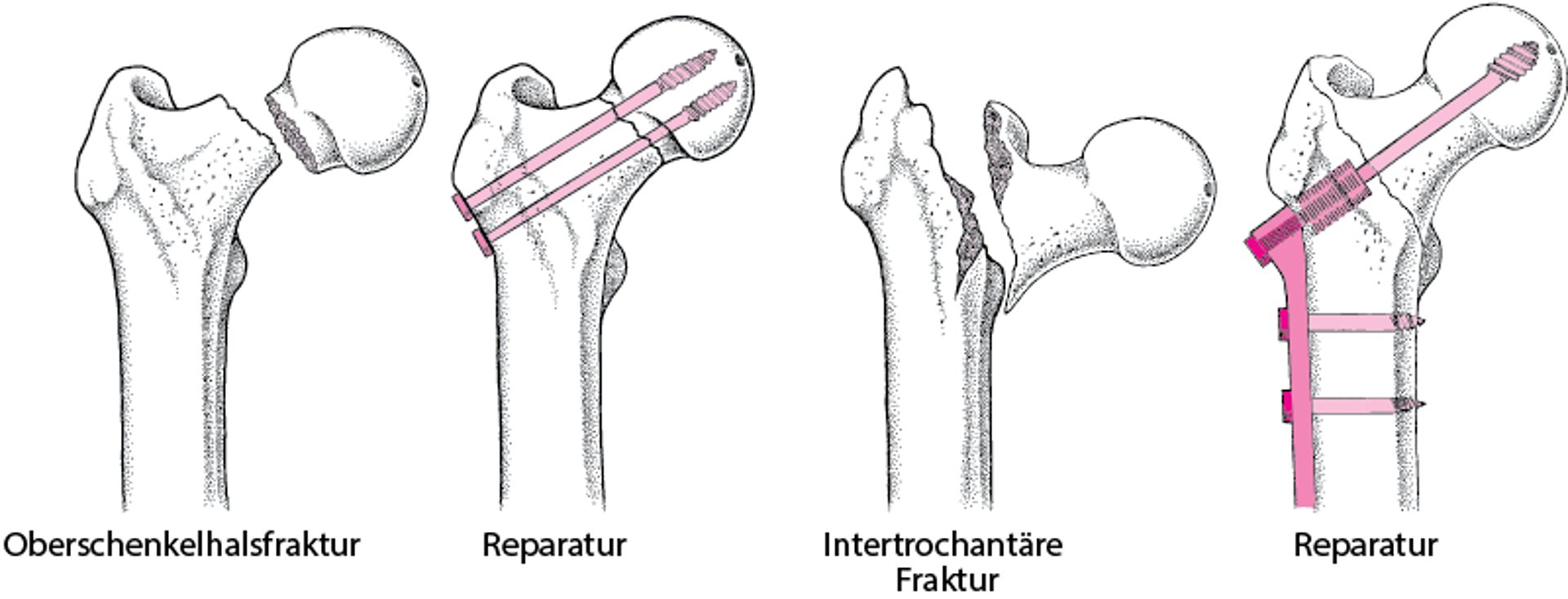 Offene Reposition mit interner Fixierung (ORIF)