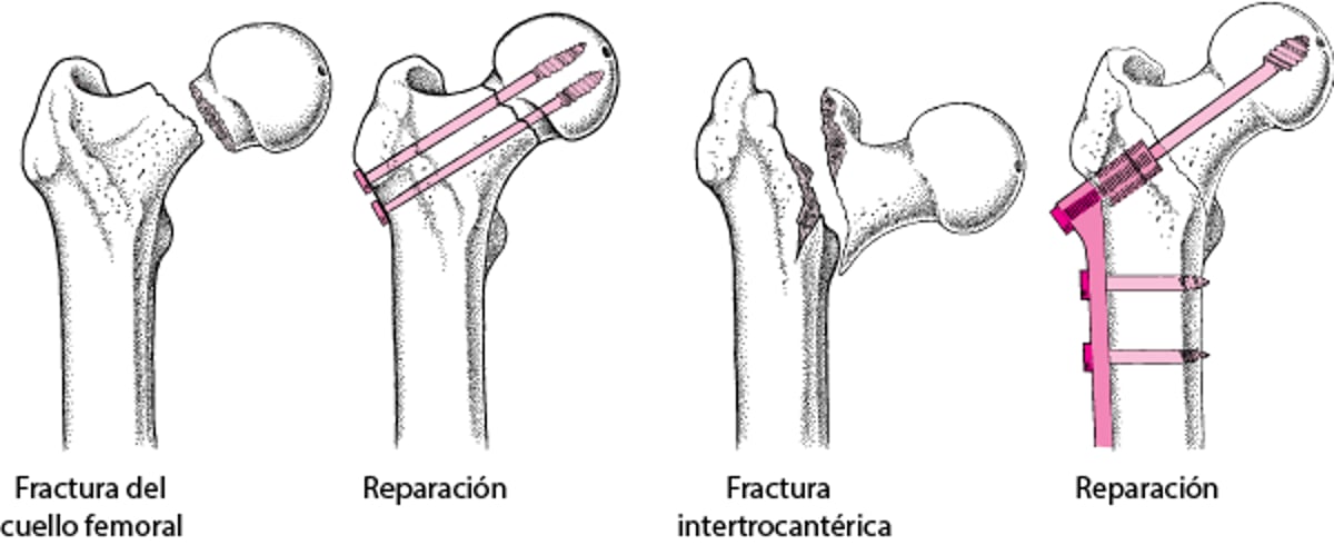 Reducción abierta con fijación interna (RAFI)