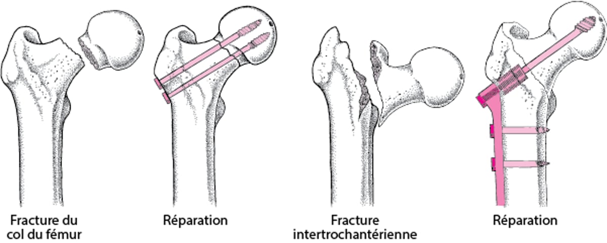 Réduction sanglante avec ostéosynthèse interne
