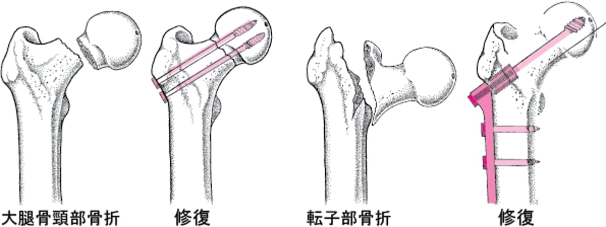 観血的整復内固定術（ORIF）