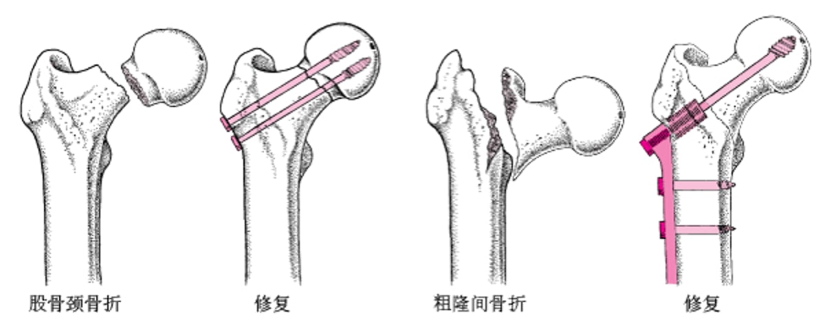 切开复位内固定 (ORIF)