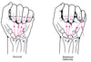 Rotational deformity due to a fracture in the hand