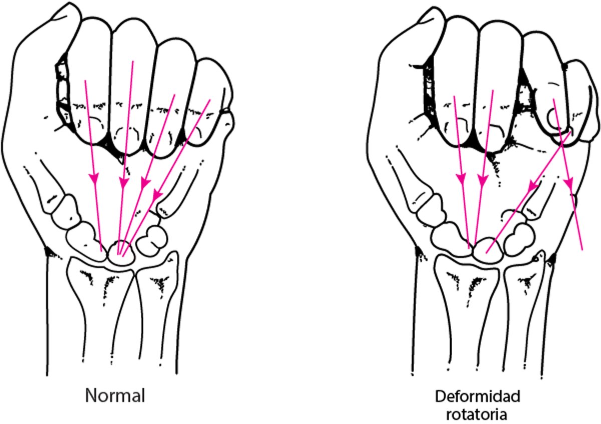 Deformidad rotatoria debido a una fractura en la mano