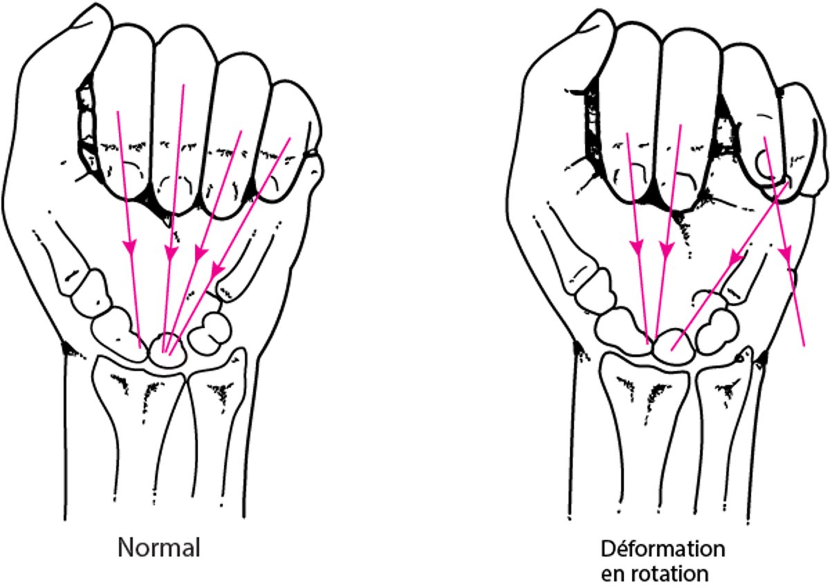 Déformation en rotation en raison d'une fracture de la main