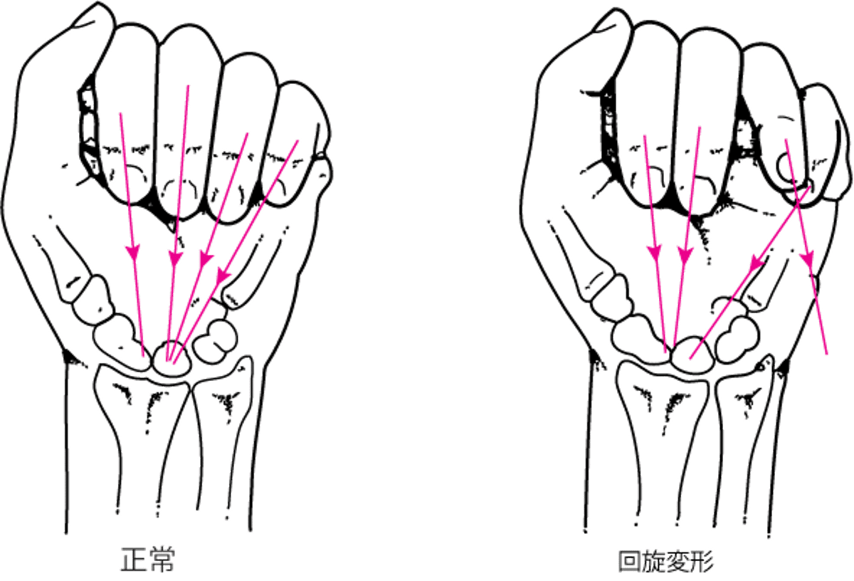 手の骨折による回旋変形