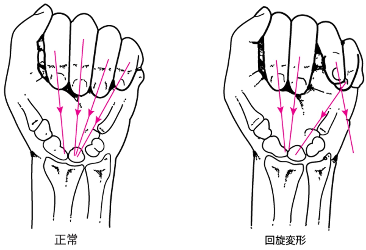 手の骨折による回旋変形