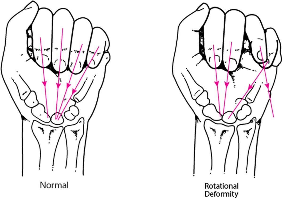 Deformidade rotacional decorrente de fratura na mão
