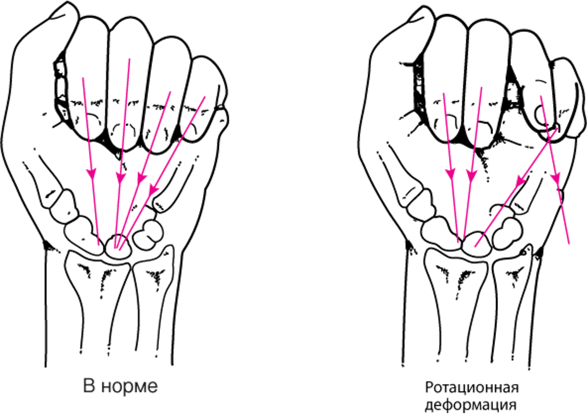 Вращательная деформация при переломе кисти