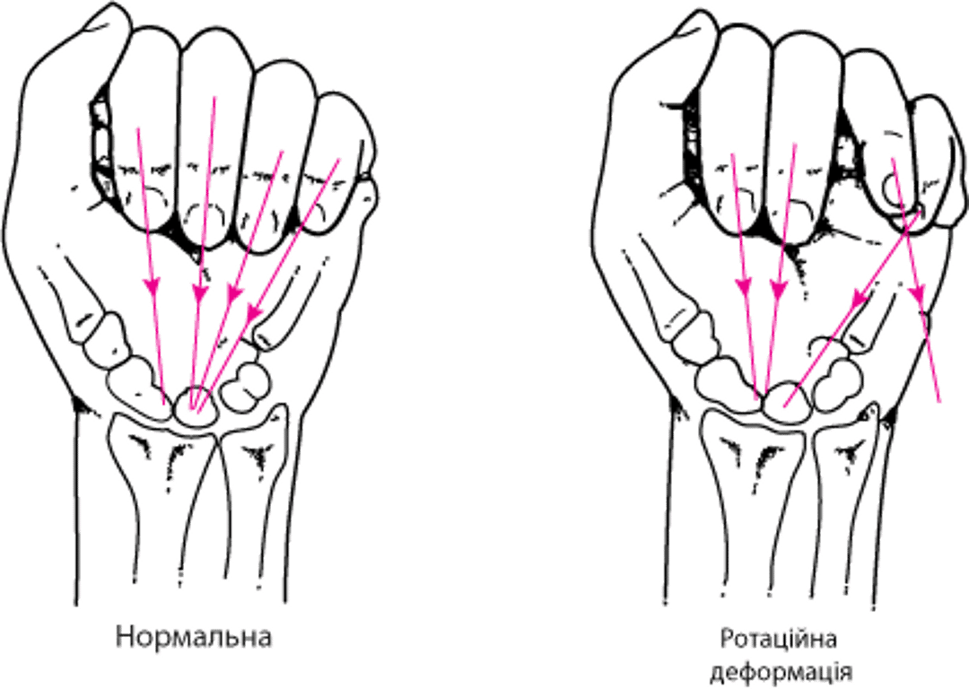 Ротаційна деформація внаслідок перелому кисті руки