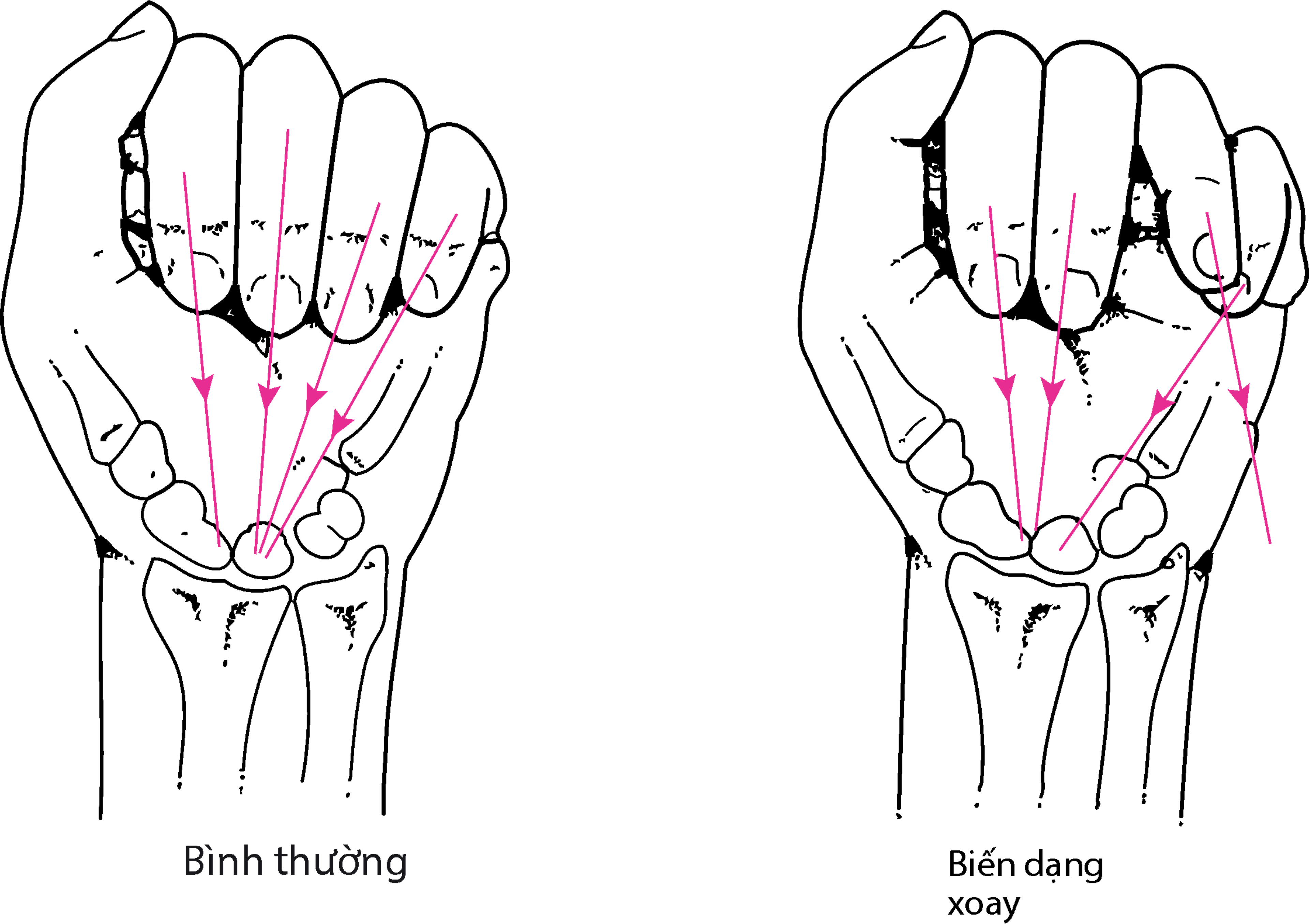 Biến dạng xoay do gãy xương bàn tay