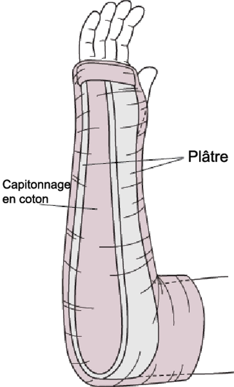 Attelle pince à sucre (attelle en gouttière cubitale)