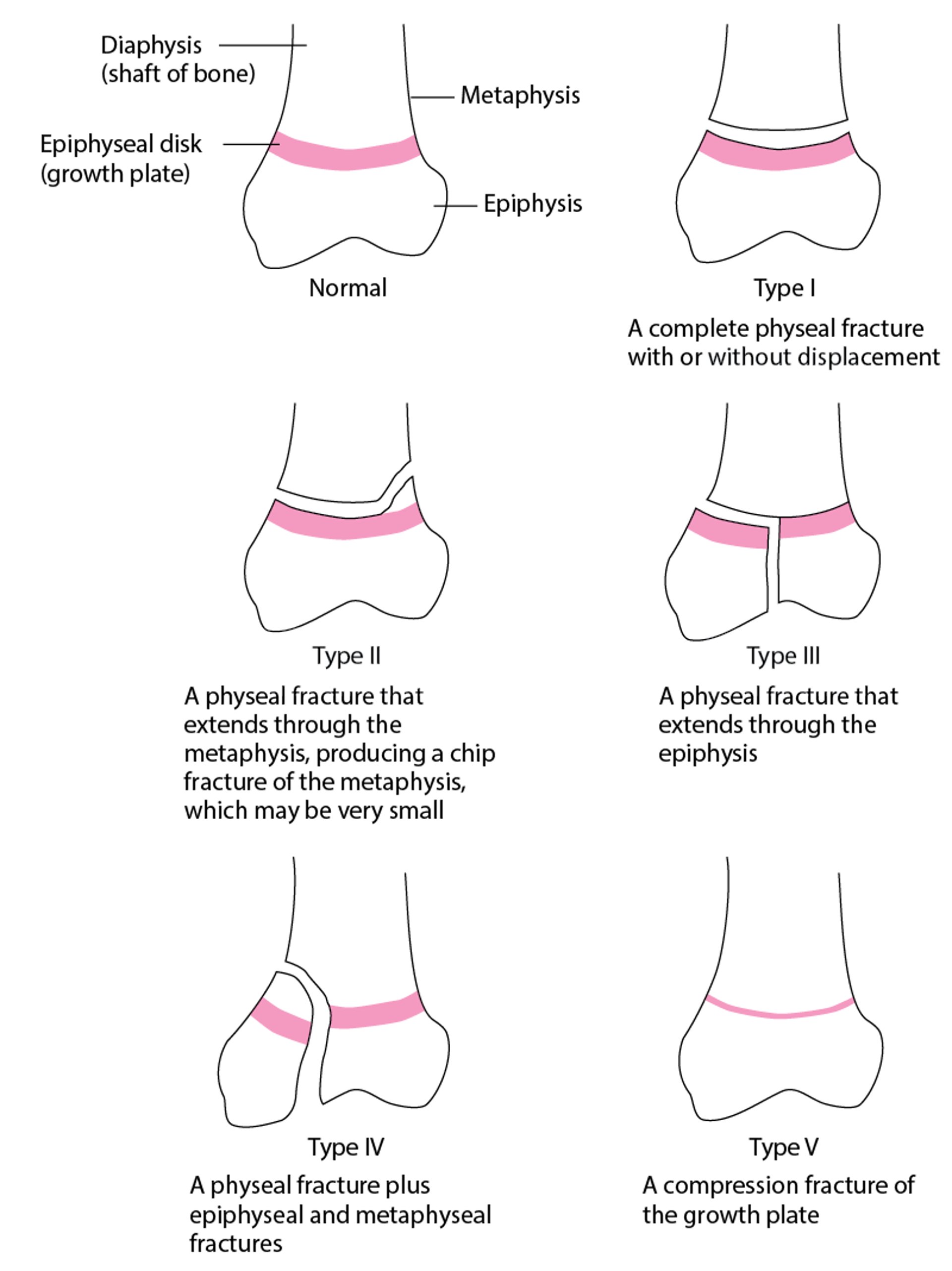 Salter-Harris classification of physeal disk (growth plate) fractures