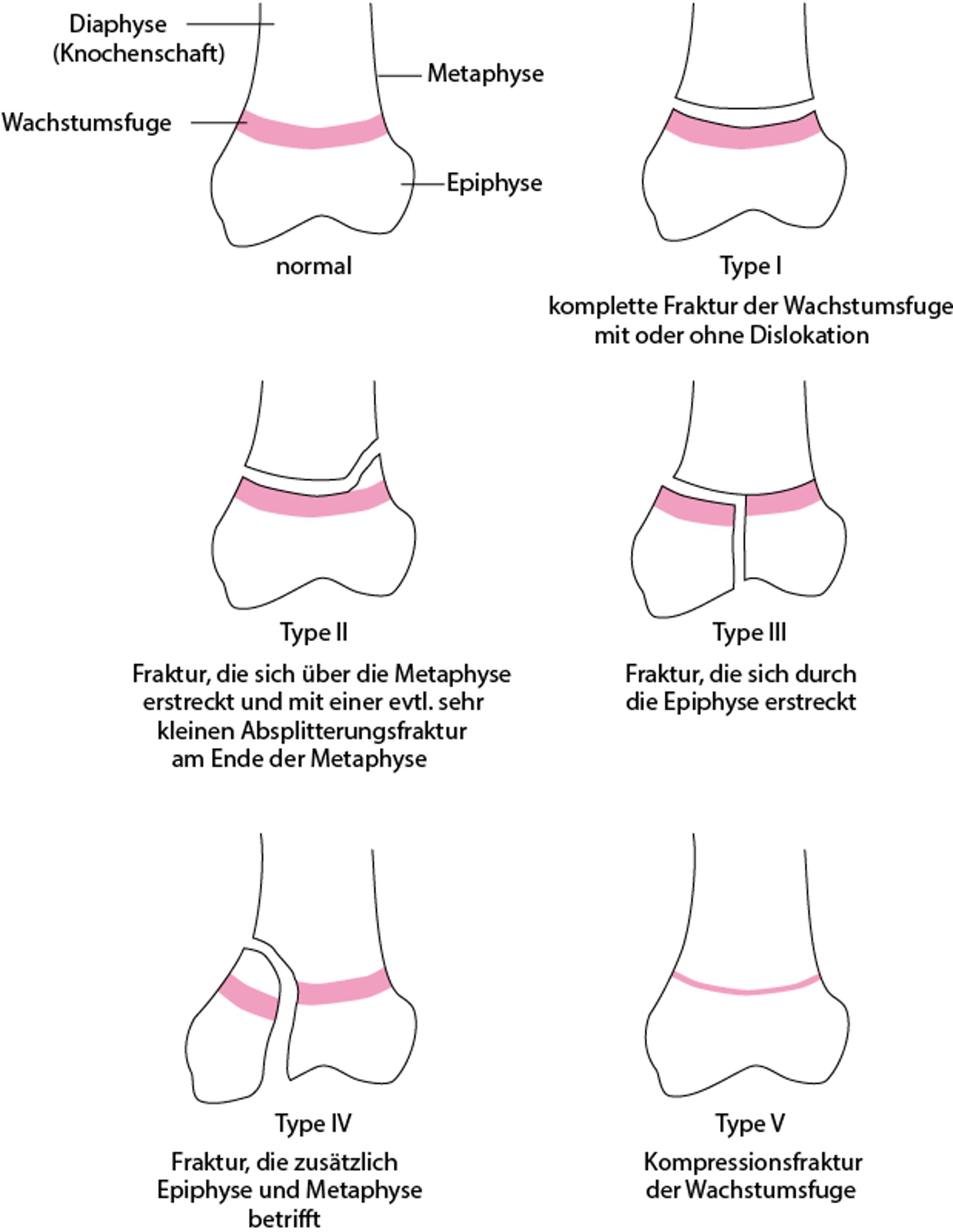 Salter-Harris-Klassifizierung der physären Scheiben- (Wachstumsfugen-) Frakturen