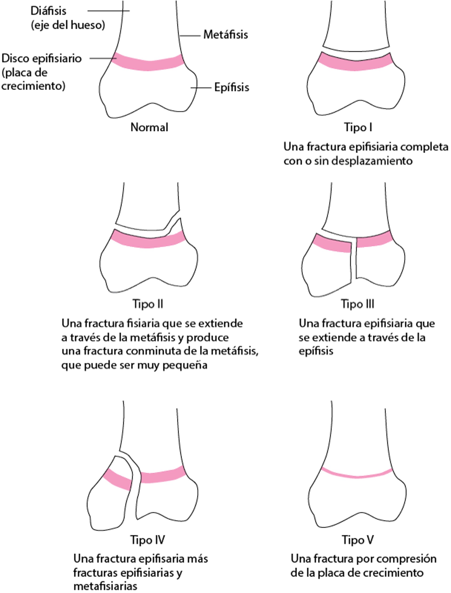 Clasificación de Salter-Harris de las fracturas de disco fisarios (placa de crecimiento)