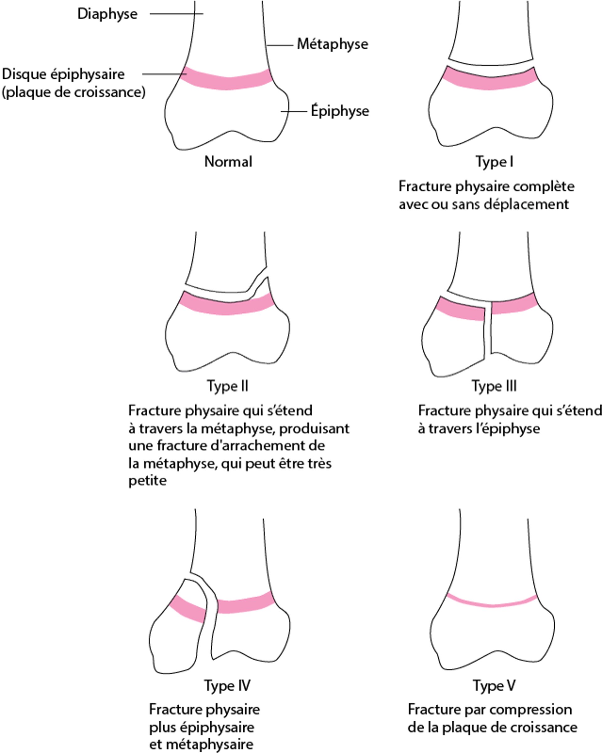Classification de Salter-Harris pour les fractures-décollement des disques ou plaques épiphysaires (cartilages de conjugaison)