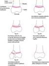 Classificazione di Salter-Harris delle fratture (fisarie) della cartilagine di accrescimento