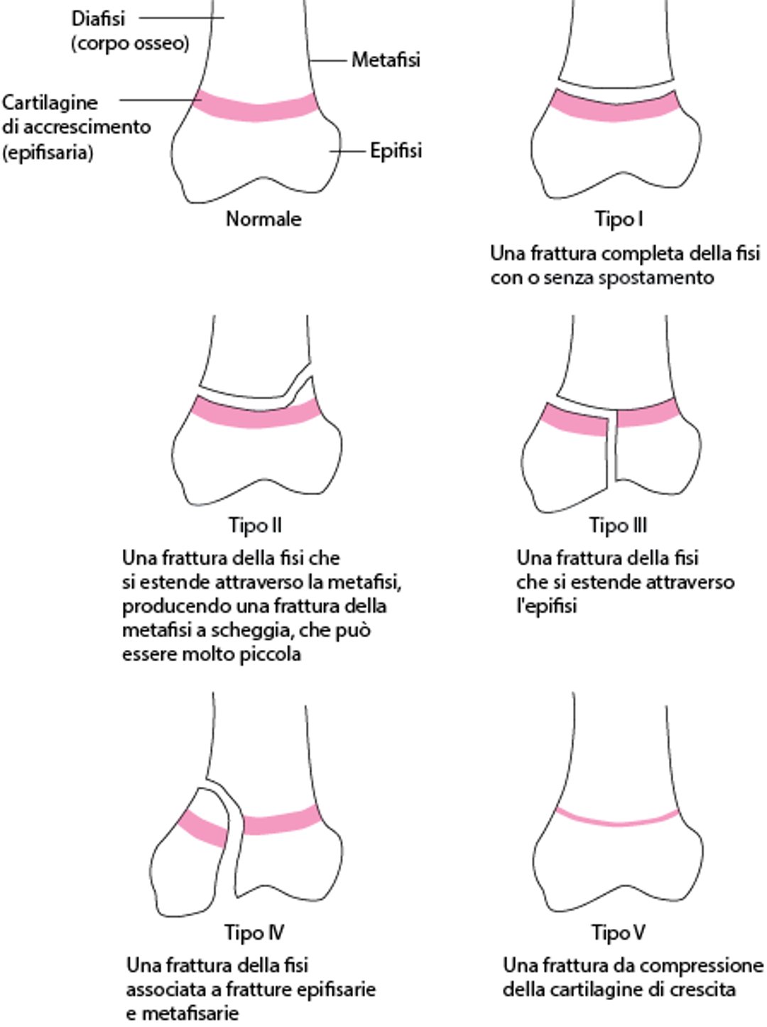 Classificazione di Salter-Harris delle fratture (fisarie) della cartilagine di accrescimento