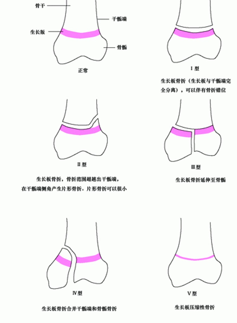 骨骺（生长板）骨折的Salter-Harris分类系统
