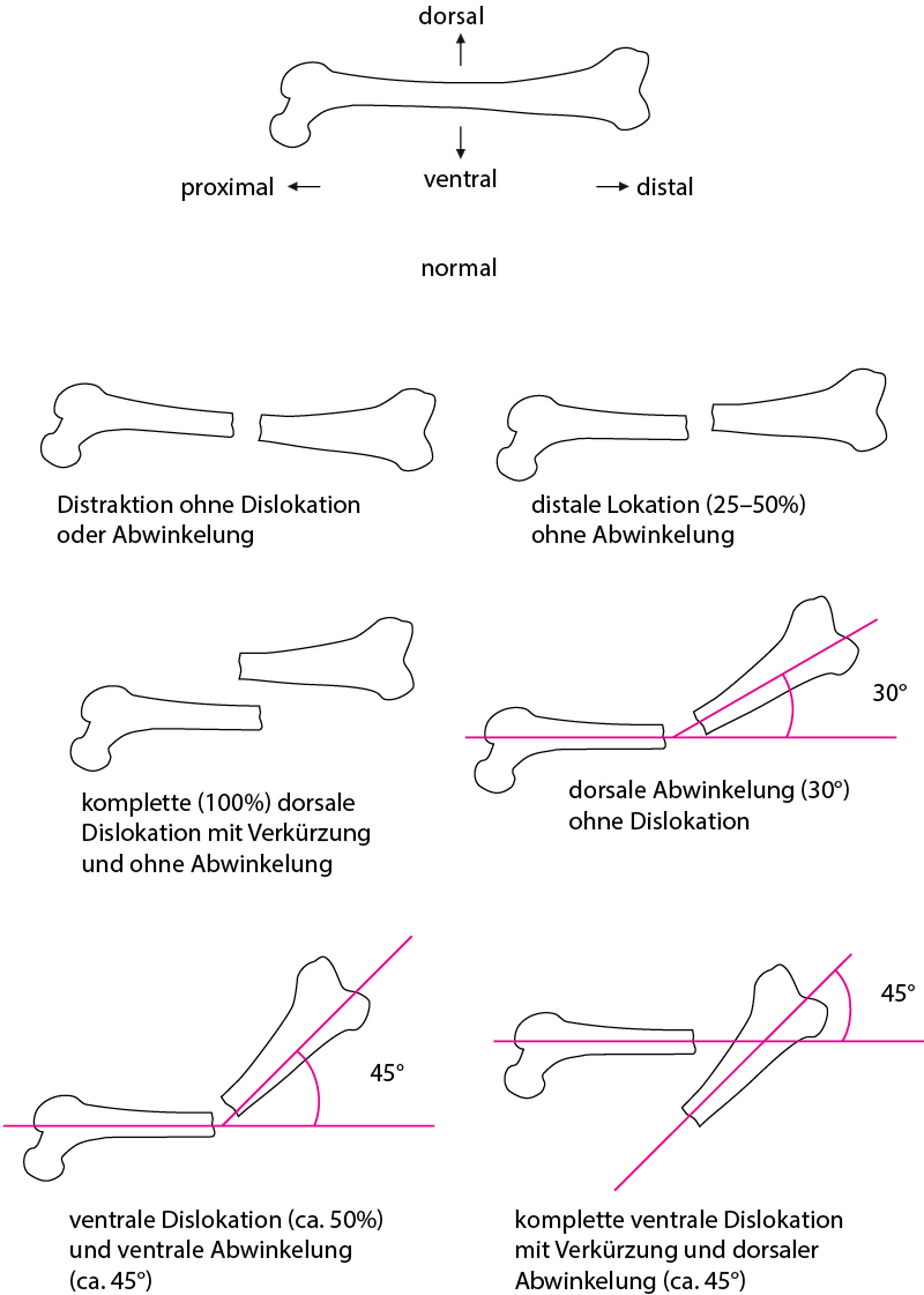Räumliche Beziehung zwischen Frakturfragmenten