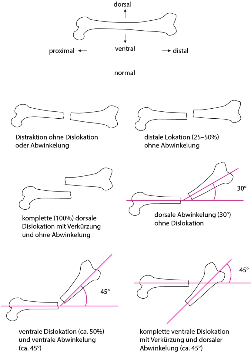 Überblick über Frakturen - Überblick über Frakturen - MSD Manual Profi ...