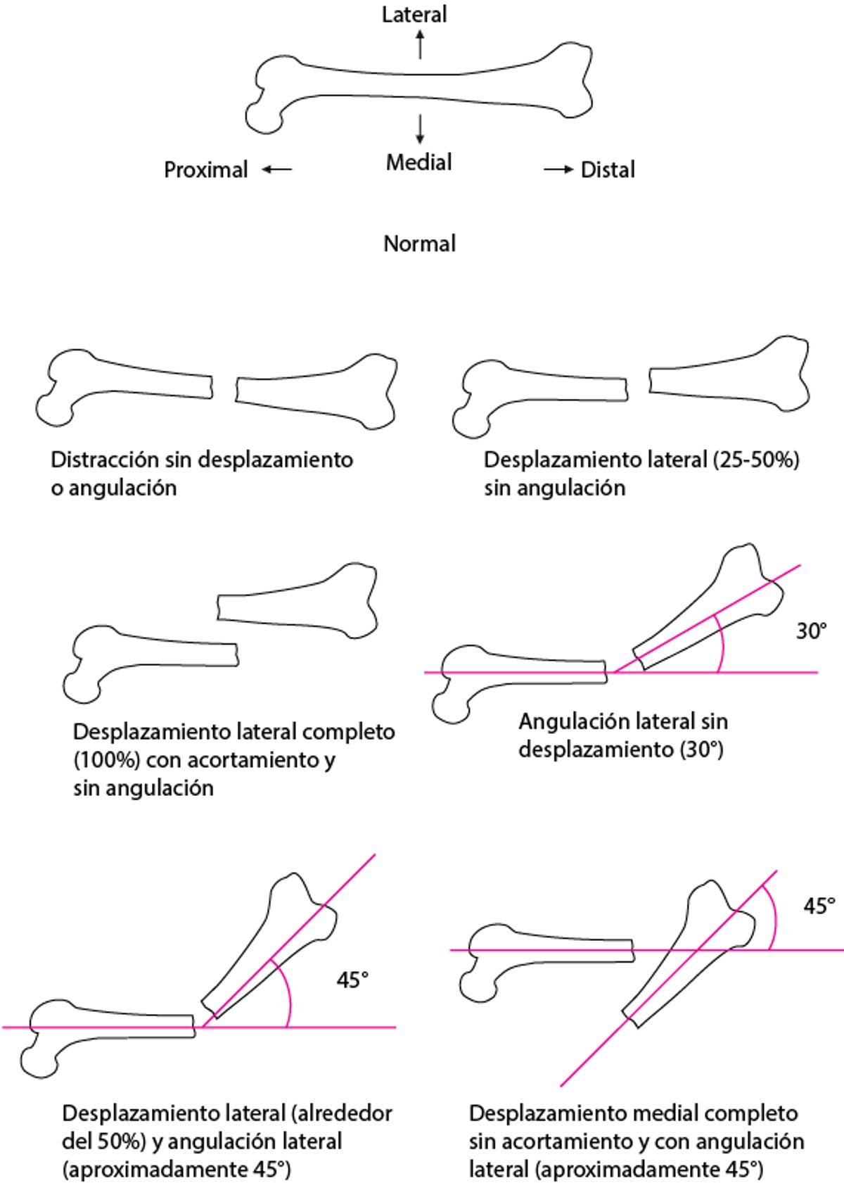 Relación espacial entre los fragmentos de la fractura