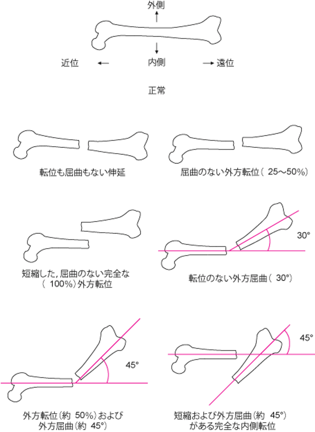 骨片間の位置関係