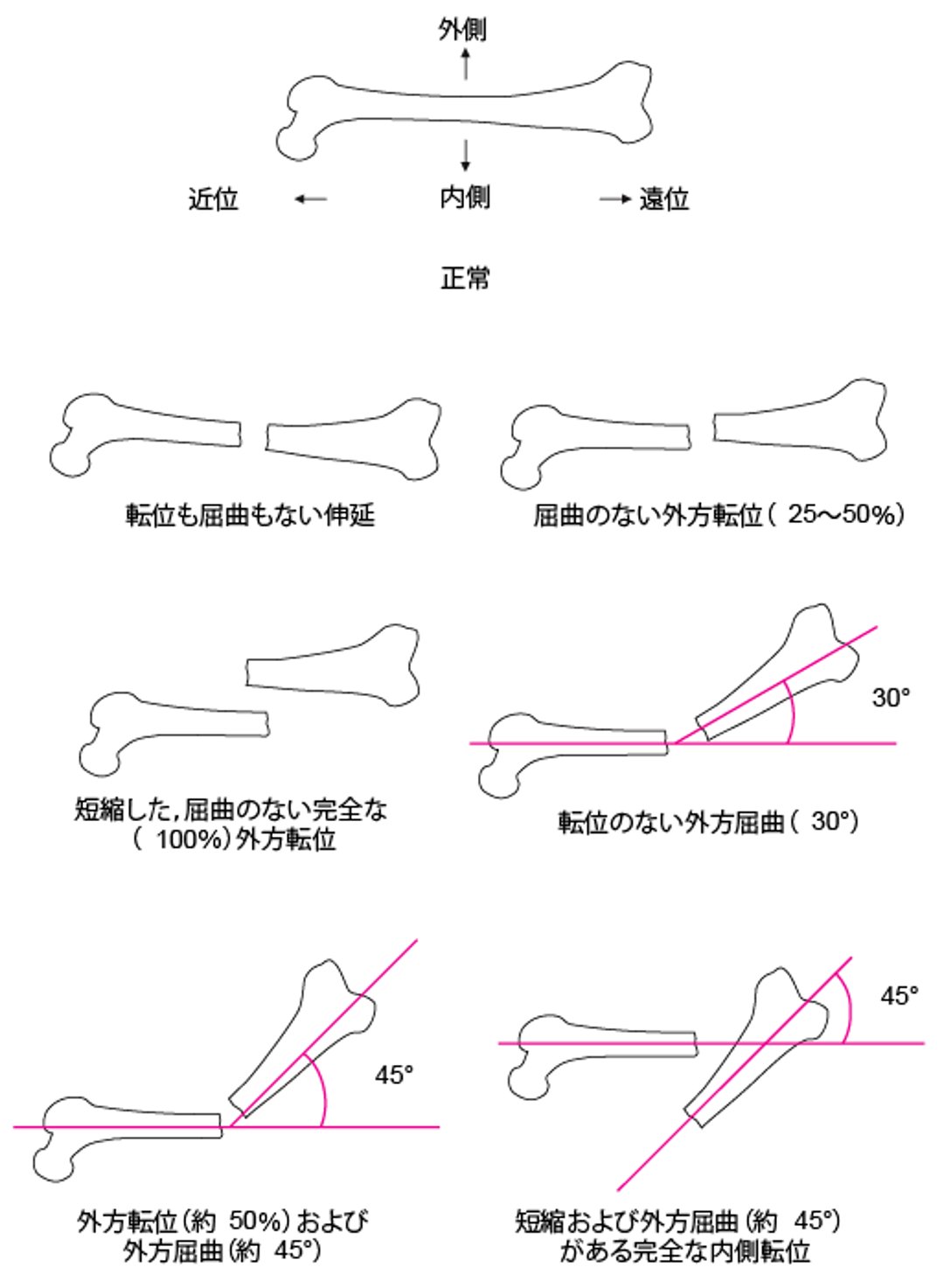 骨片間の位置関係