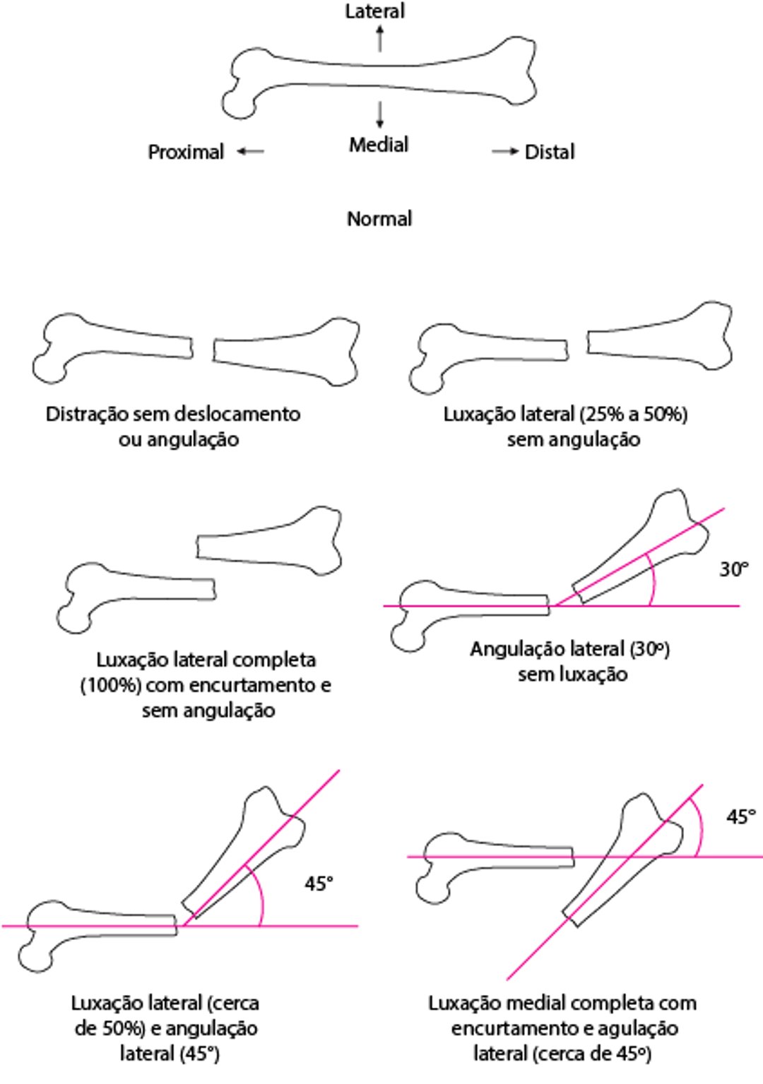 Relação especial entre fragmentos da fratura