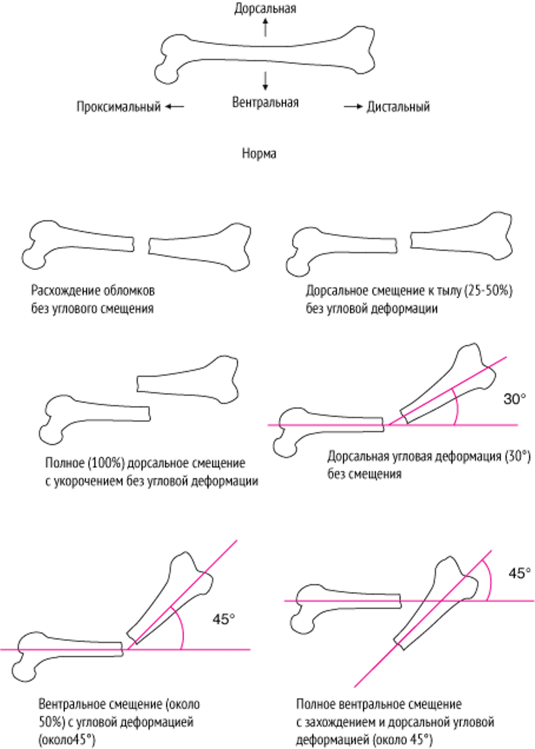 Пространственное взаимоотношение между фрагментами перелома