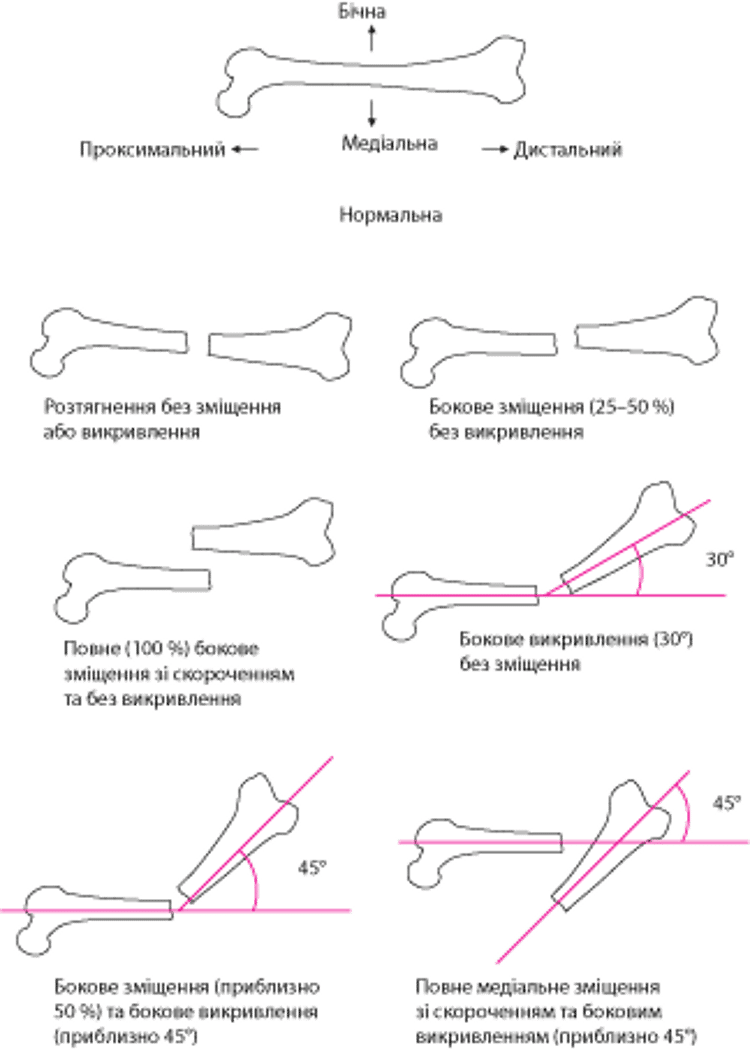Просторове співвідношення фрагментів перелому