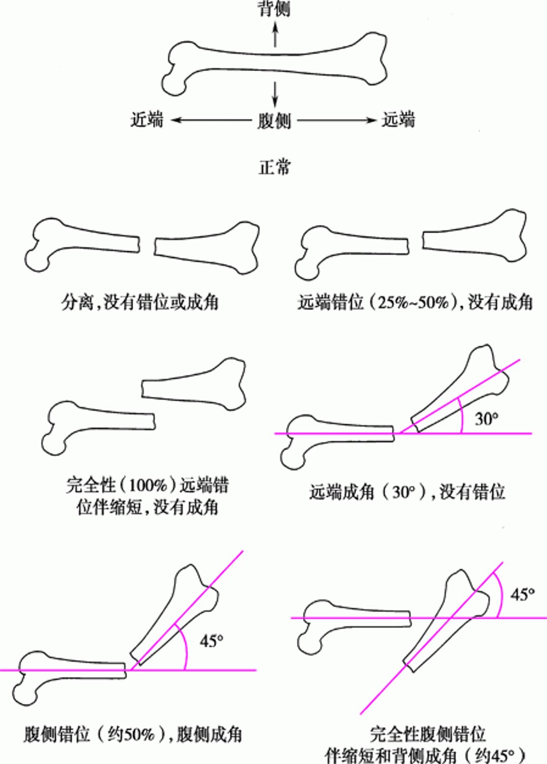 骨折片断的立体位置关系