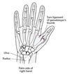 Torn ulnar ligament