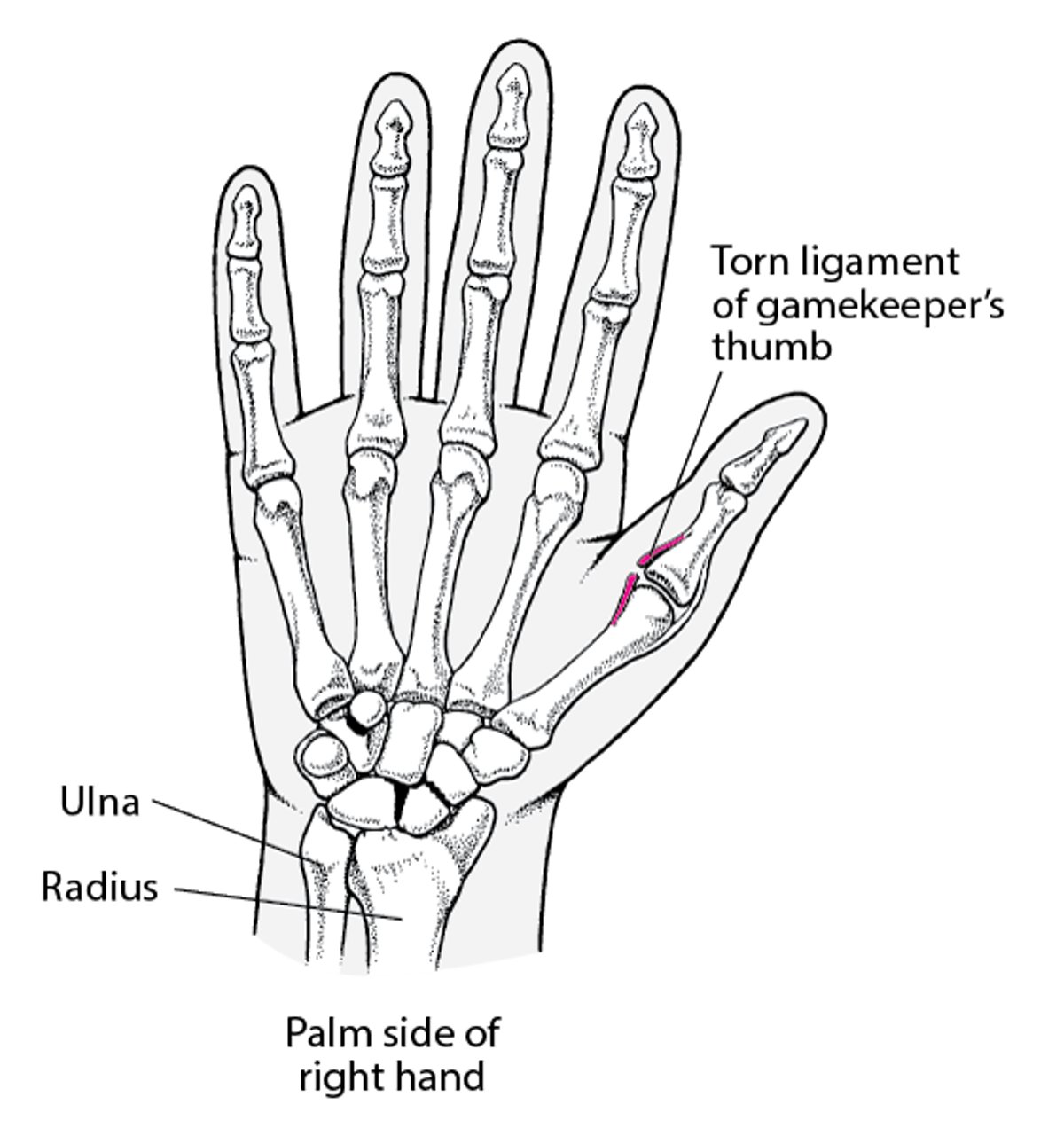 Torn ulnar ligament