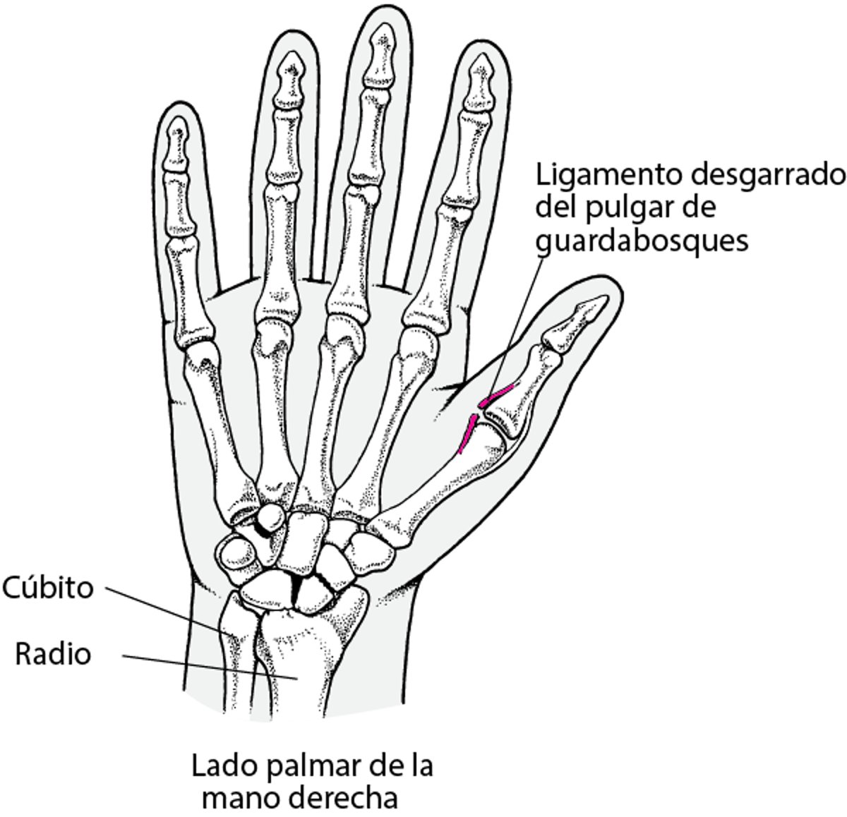 Ligamento cubital desgarrado