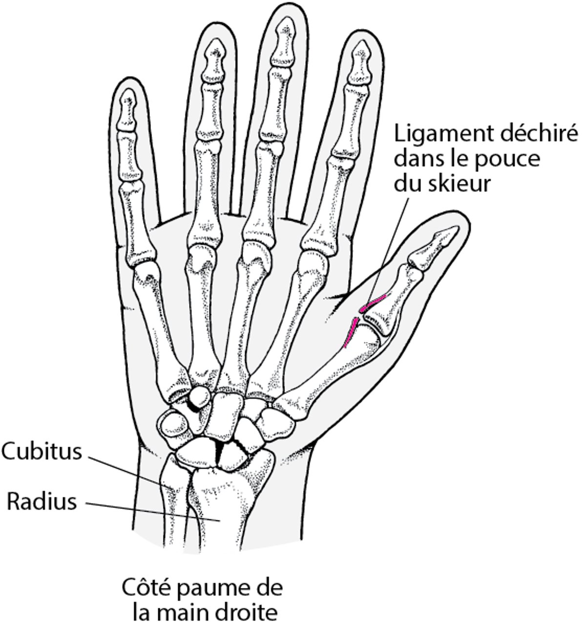 Ligament ulnaire déchiré