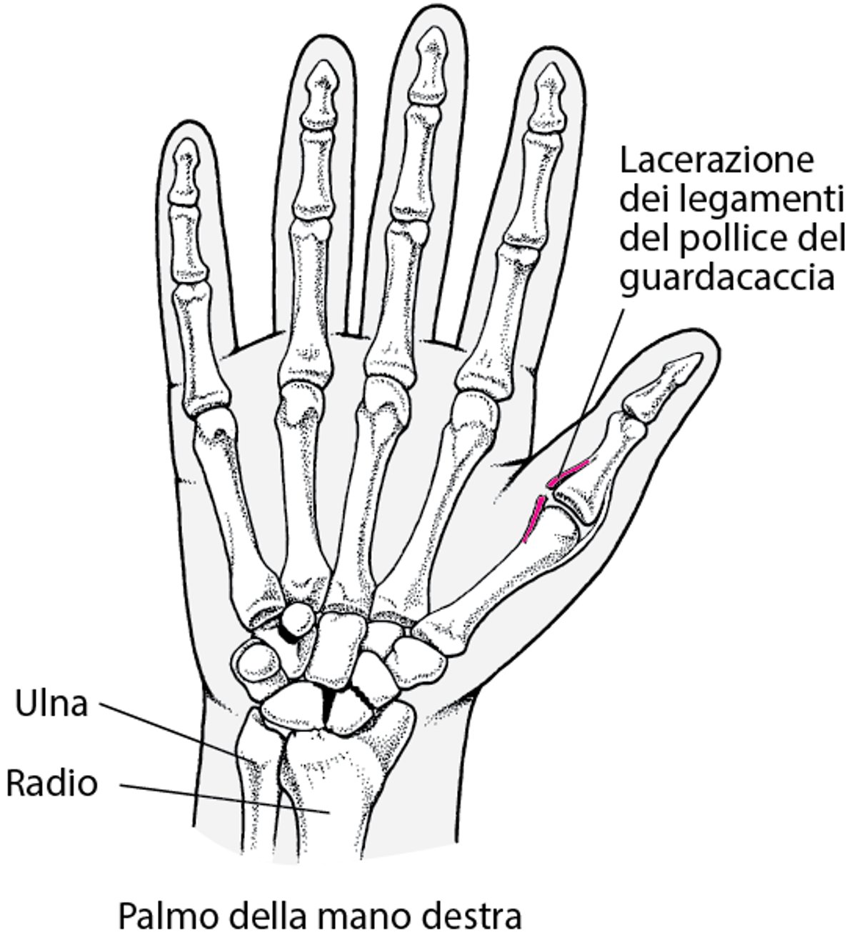 Legamento ulnare lacerato