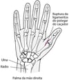 Ruptura do ligamento ulnar