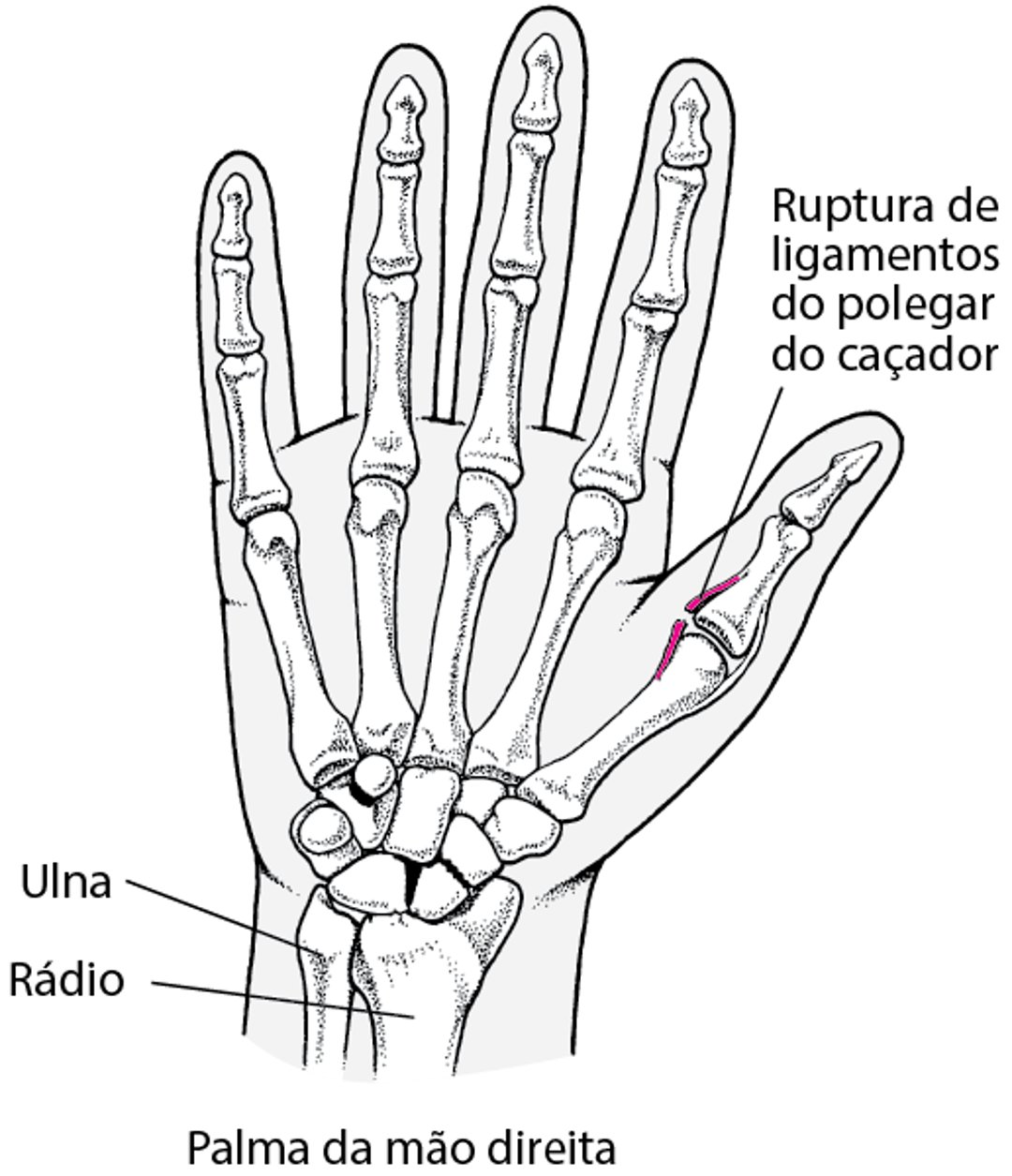 Ruptura do ligamento ulnar