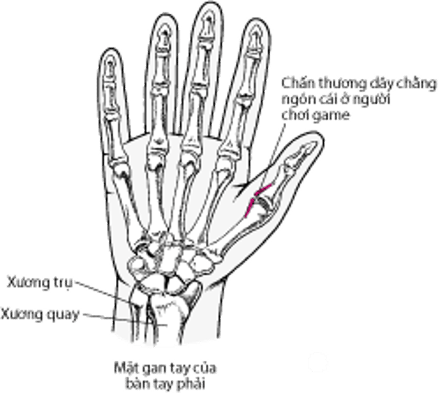 Rách dây chằng bên trụ