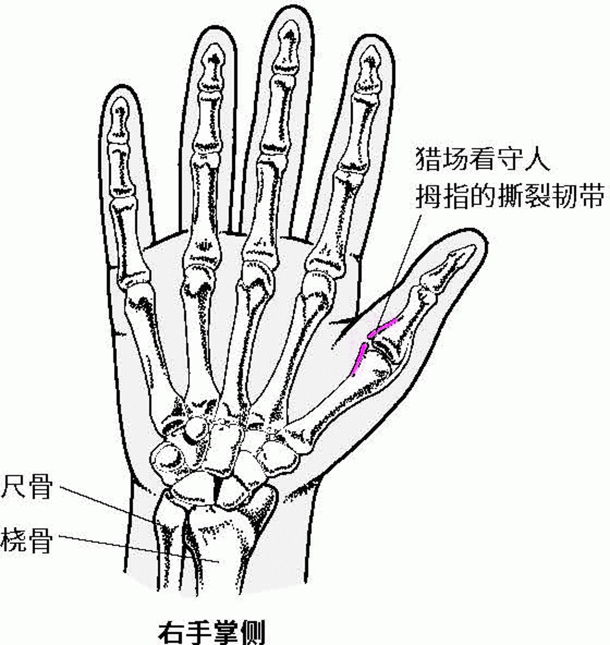 撕裂的尺侧韧带