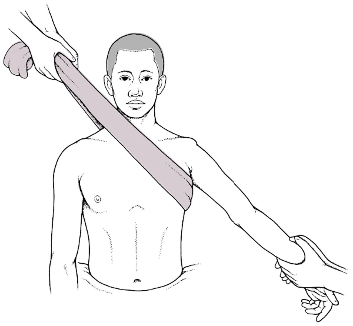 Zug-Gegenzug-Technik zur Reduzierung von anterioren Schulterluxationen