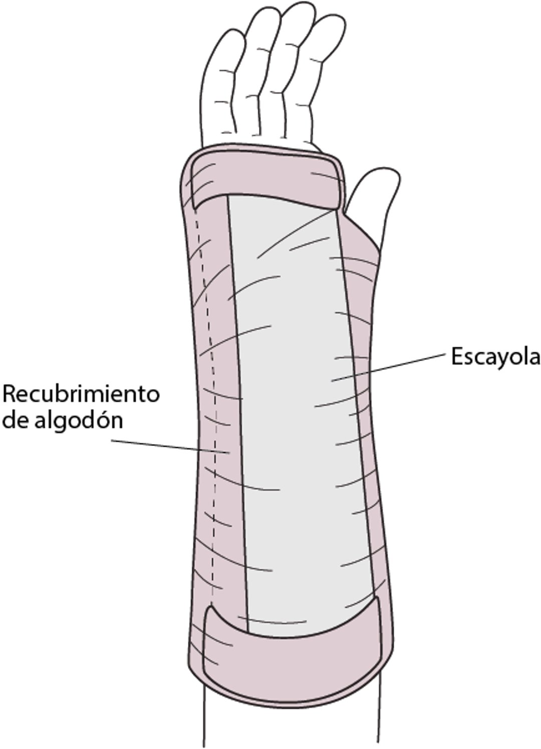 Entablillado volar