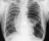 Large (Tension) Pneumothorax
