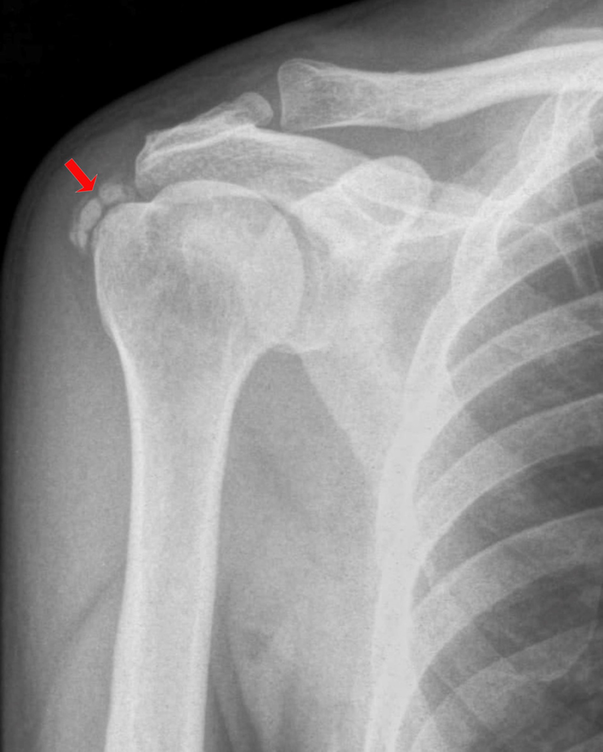 Calcific Tendinopathy