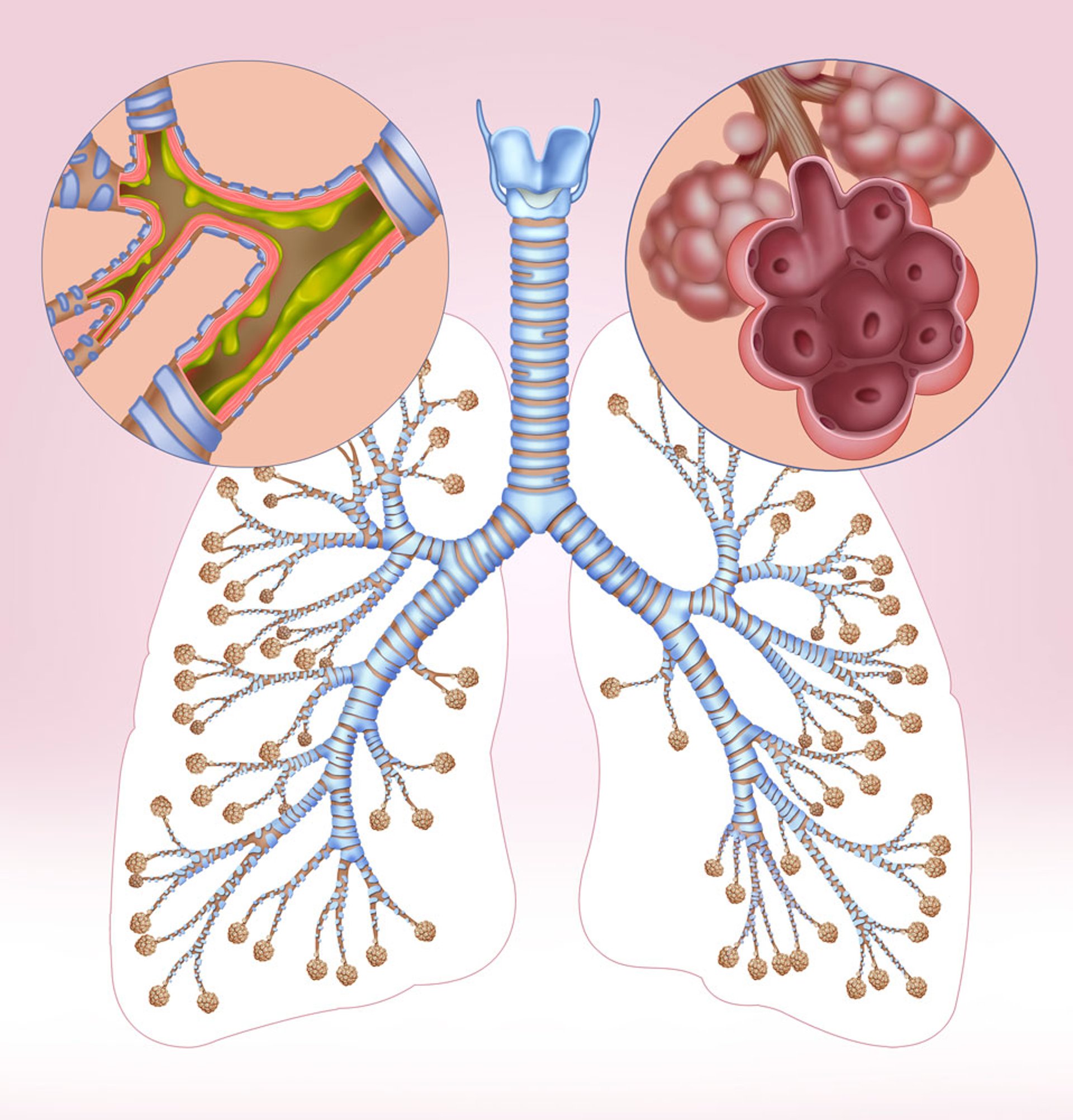 Emphysema and Bronchitis (Illustration)