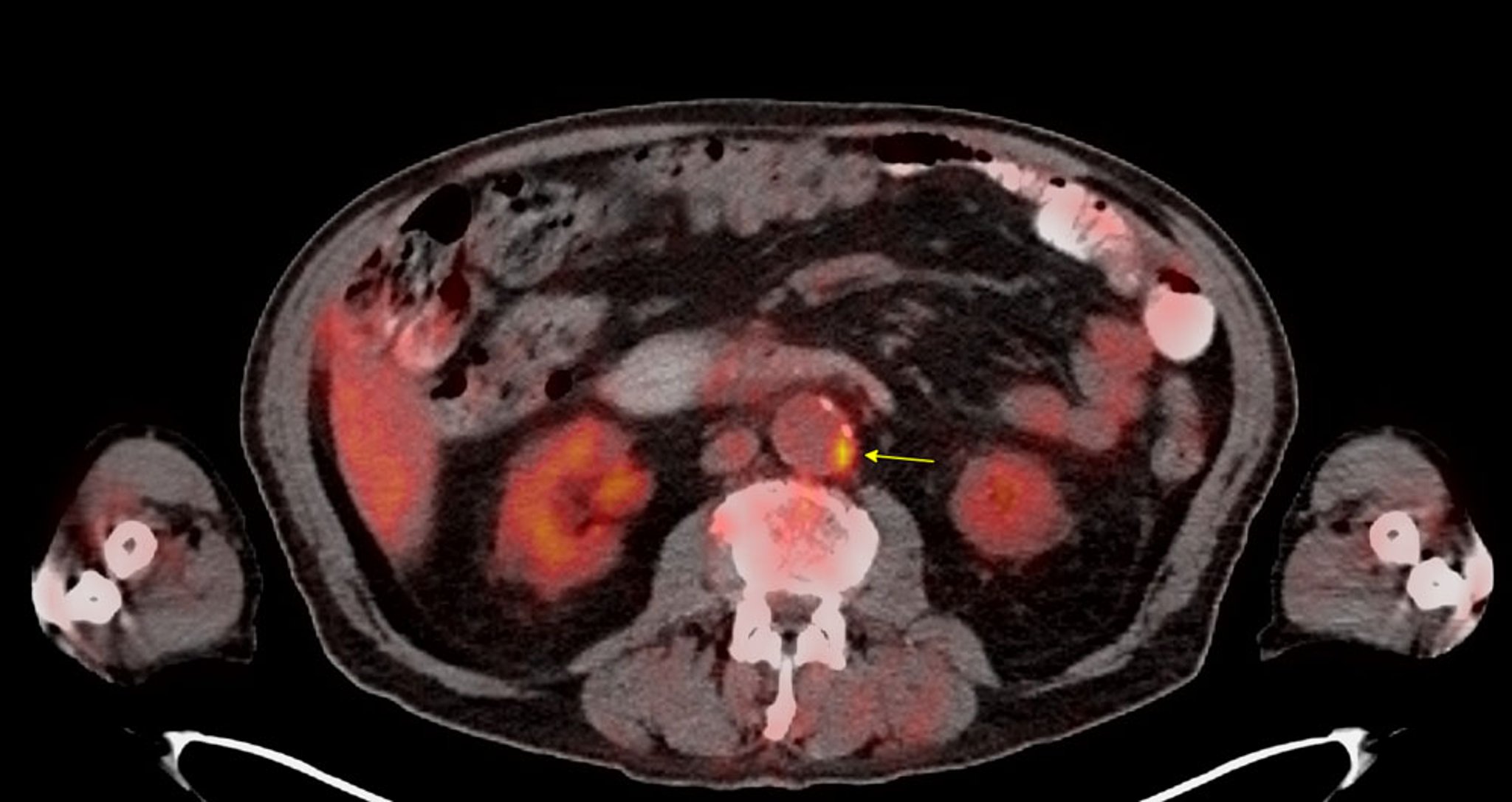 氟-18标记脱氧葡萄糖（FDG）/正电子发射断层扫描（PET）