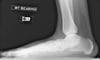 Radiographie du pied plat